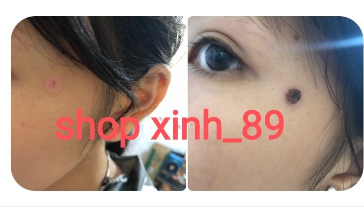 kem tẩy nốt ruồi, mụn cóc, mụn thịt , mắt cá chân