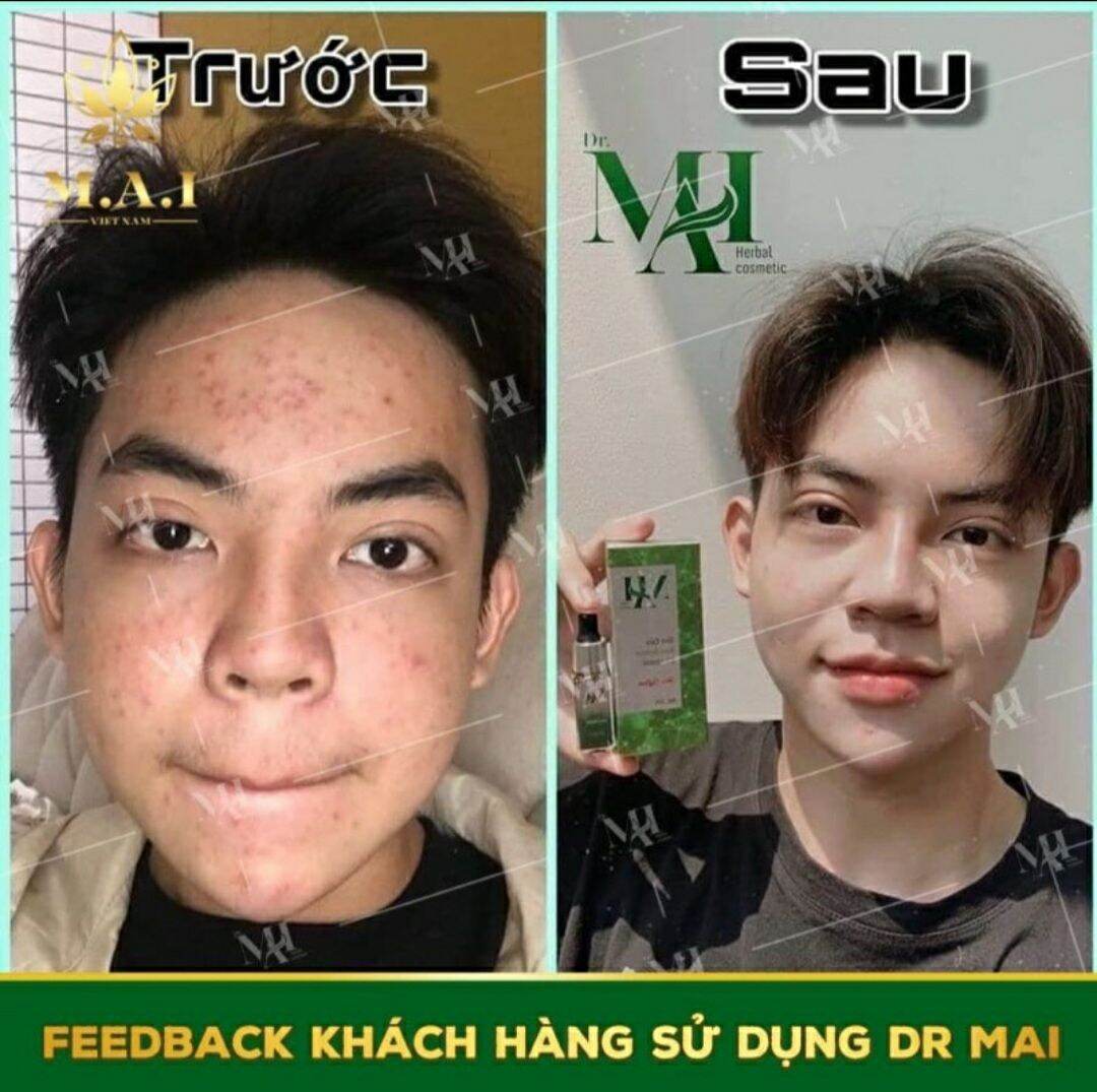 Serum Mụn Thảo Mộc Dr Mai