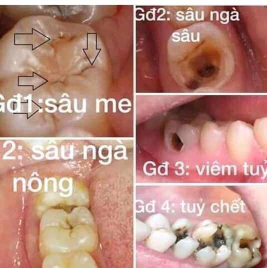 combo 2 lọ khoi hoàn toàn sâu răng