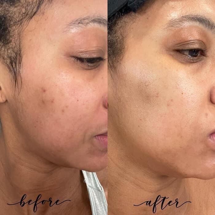 SERUM ILUMA IMAGE MỜ NÁM - MỜ THÂM - TRẮNG DA ( NHẬP KHẨU )