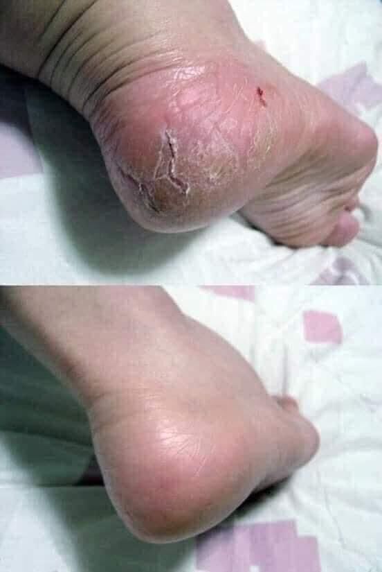 [Chính hãng] Kem nứt gót chân foot care cream Hàn Quốc