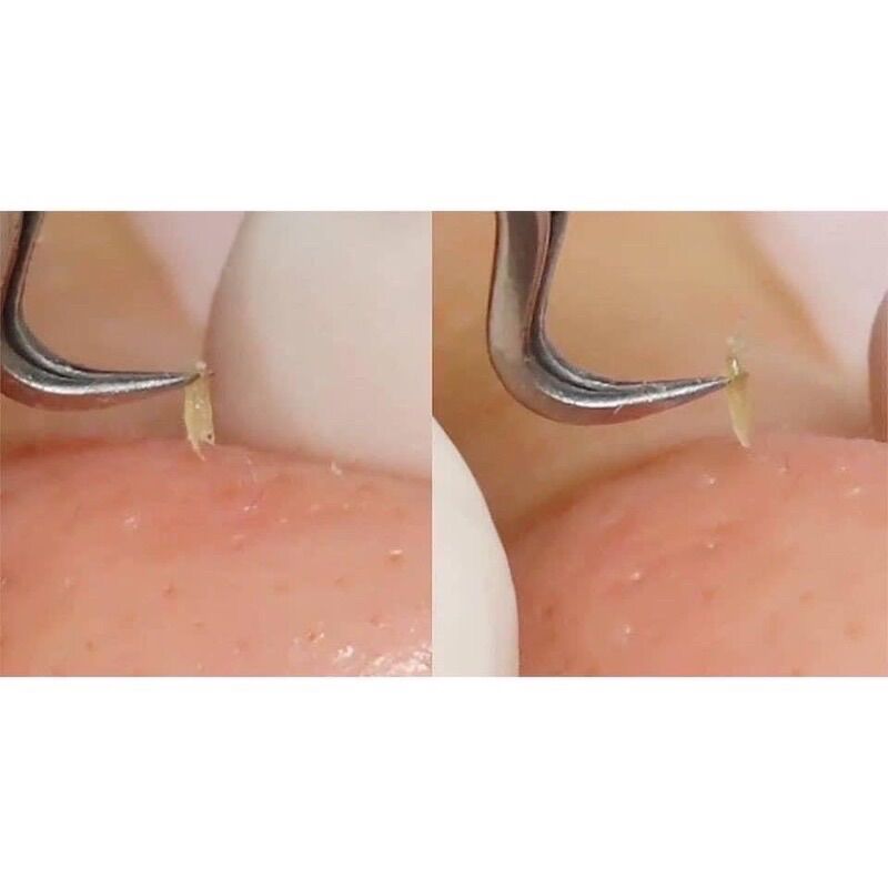 Nhíp cong gắp mụn đầu đen thần thánh