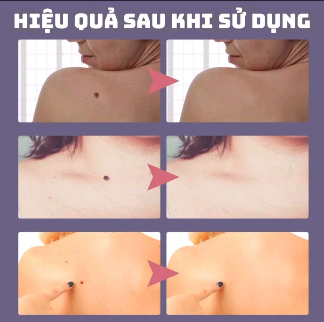 [CHÍNH HÃNG] Kem EELHOE tẩy nốt ruồi, mụn thịt