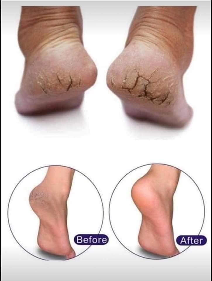Kem nứt gót Kpem của Nga