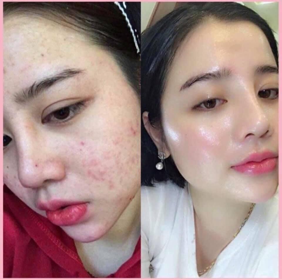 Serum Mụn Dr.skinacnes, Thảo dược sạch mụn, sạch thâm