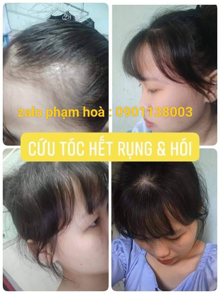 [Mua 4 chai Tặng 1chai ] Tinh Dầu Bưởi Mọc Tóc,Ngăn Rụng Tóc, Giúp Dài Tóc 3-6cm/1 tháng , Tóc Khỏe