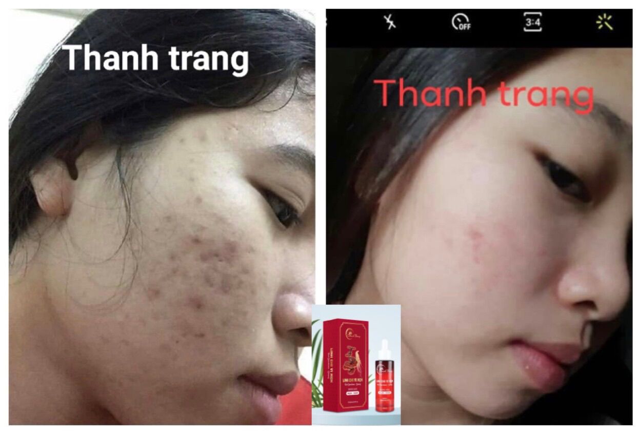 Combo Thảo dược hết mụn, thâm nám Thanh Trang