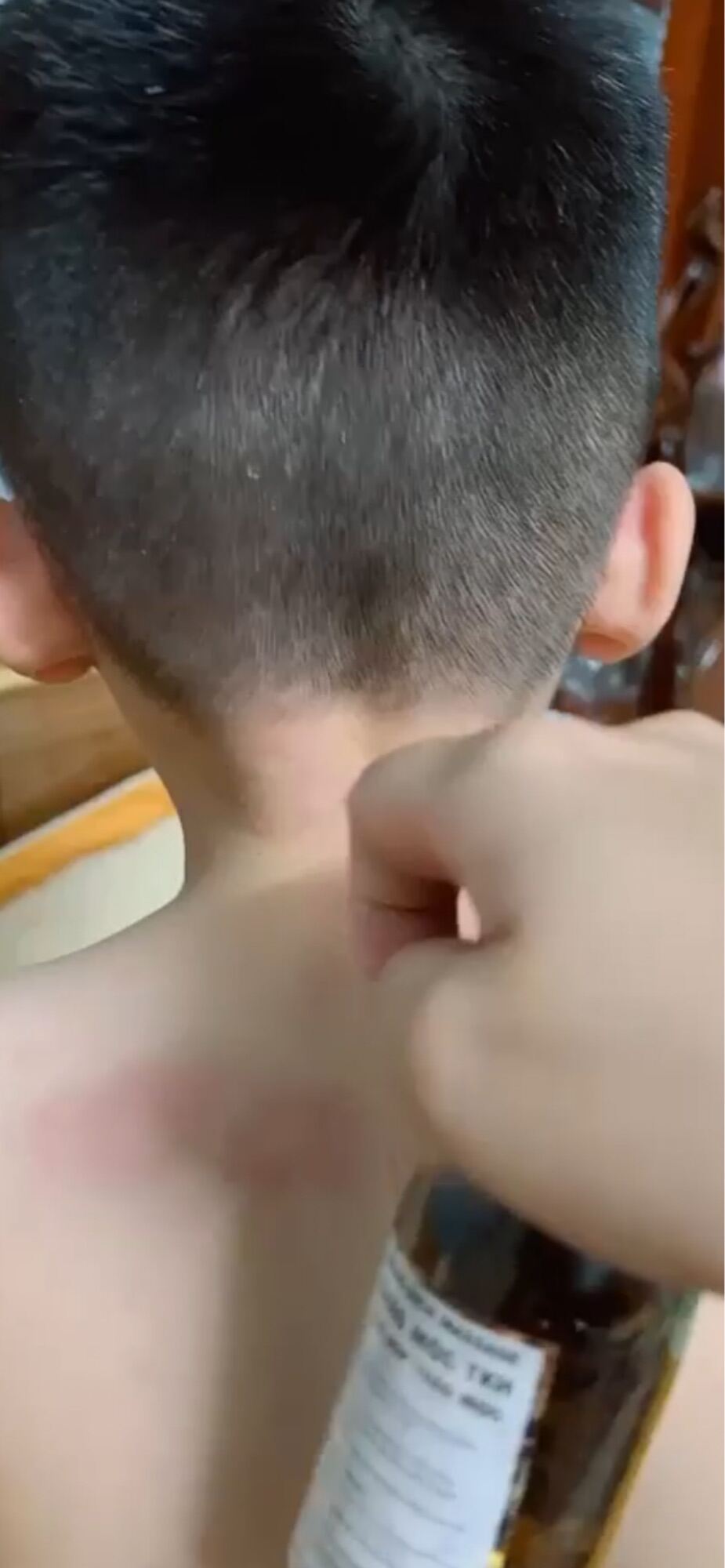 Nổi Mề đây-dị ứng