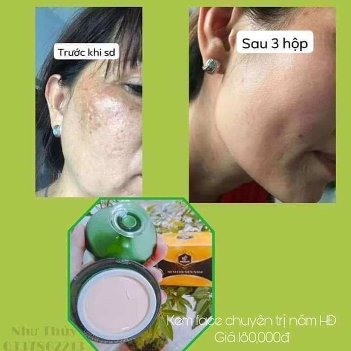 [HCM] combo chuyên nám siêu phẩm Huỳnh Đỗ