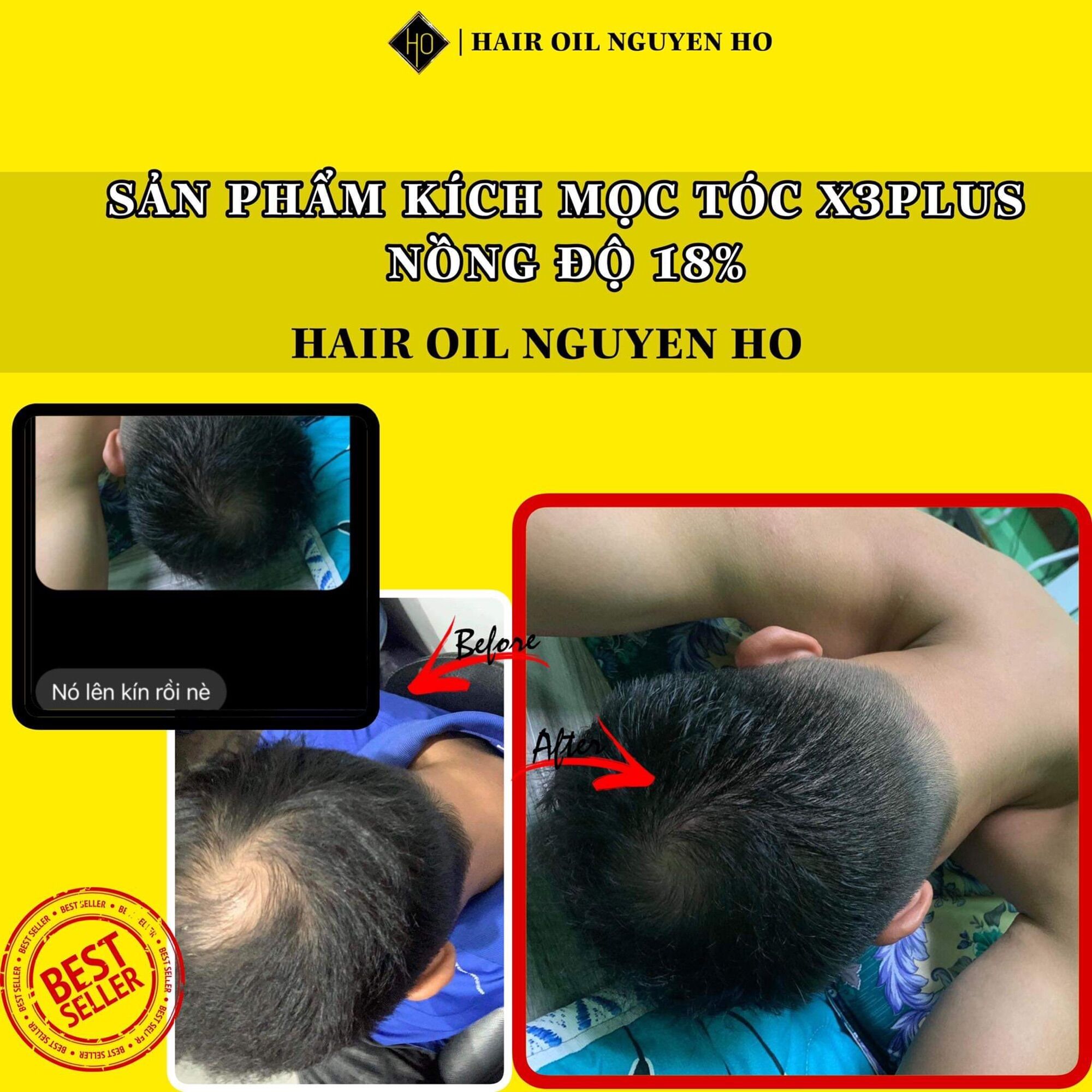 SẢN PHẨM MỌC TÓC NGUYỄN HỒ X3PLUS 18%