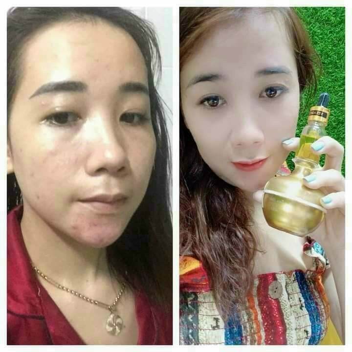 (CHÍNH HÃNG)KEM SÂM NCOLAGEN TẶNG SÉT TẨY TẾ BÀO