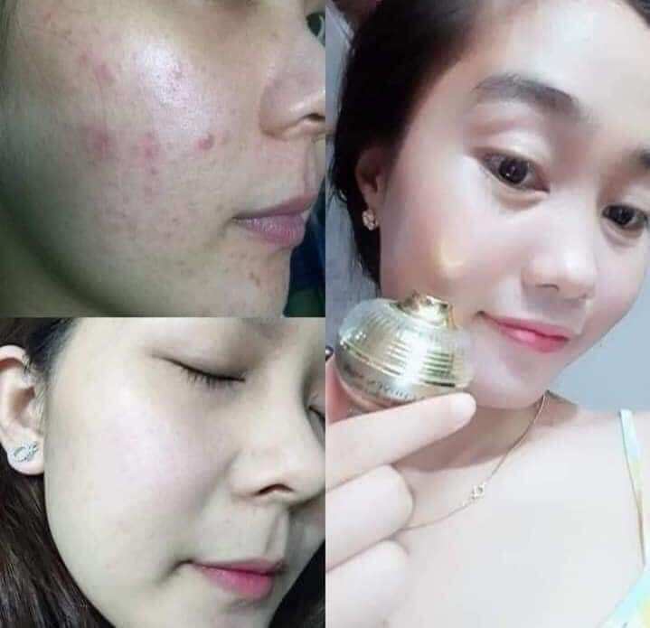 kem chuyên mụn huỳnh đỗ