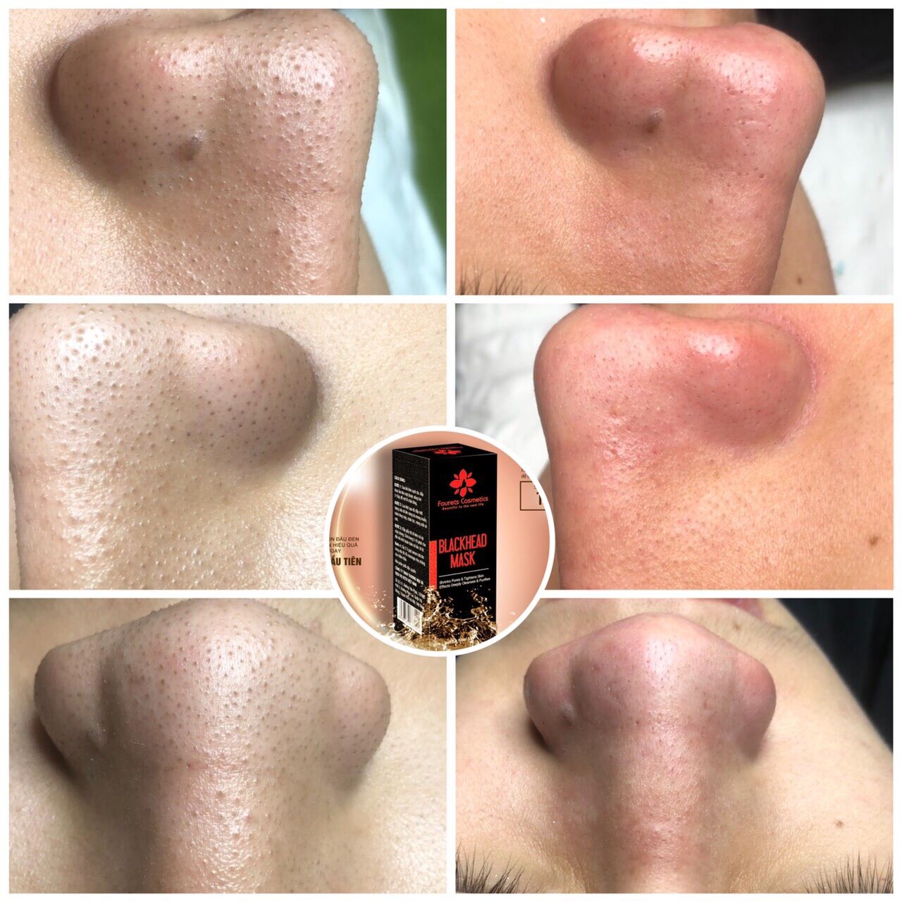 Lột mụn đầu đen blackhead mask của dr acneal bay mụn đầu đen sau 10 PHÚT