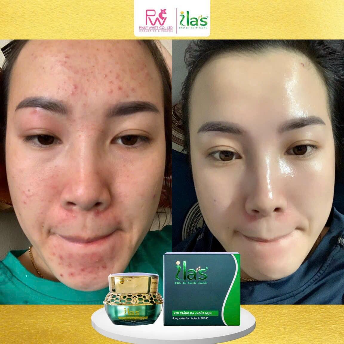 Kem Ilas Giảm Mụn Thâm ,Trắng Da _ Kem ILAS ,20gram