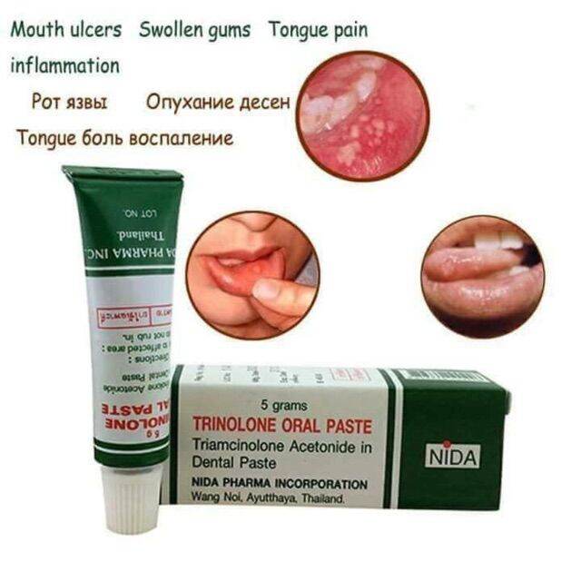 Kem nhiệt miệng , lỡ miệng Trinolone Oral Paste Thái Lan