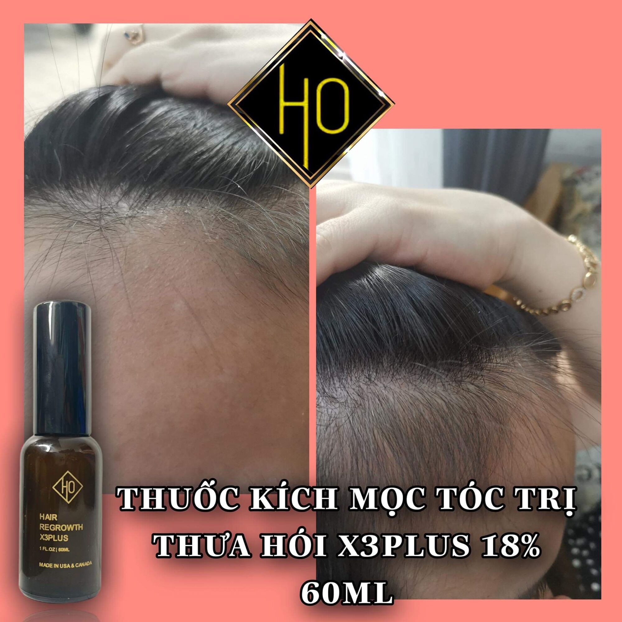 SẢN PHẨM MỌC TÓC NGUYỄN HỒ X3PLUS 18%