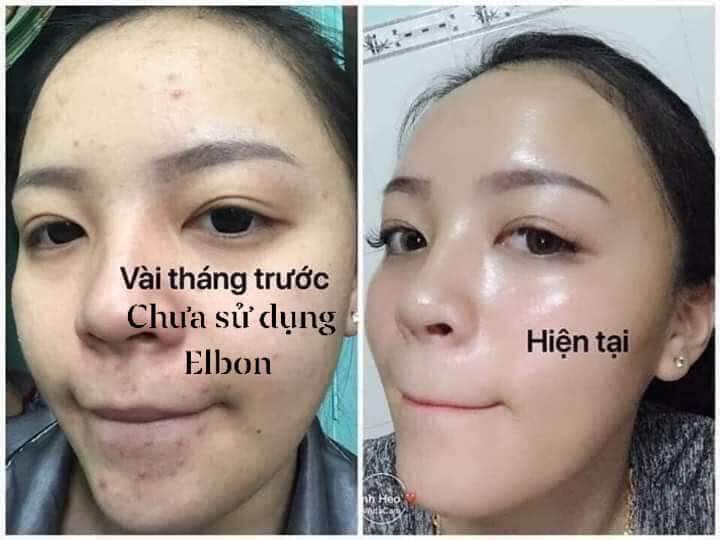KEM MỤN,MỜ THÂM,TRẮNG DA