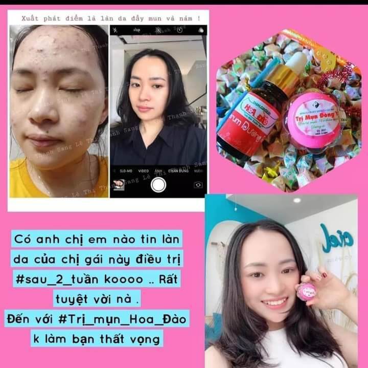 kem mụn + serum hoa đào