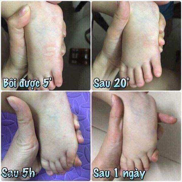 Dầu trị muỗi đốt, dầu xoa muỗi thái Lan