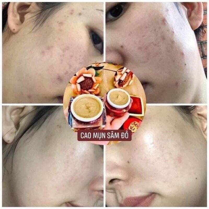 Combo Cao mụn sâm đỏ 15g + Sữa rửa mặt CHÍNH HÃNG