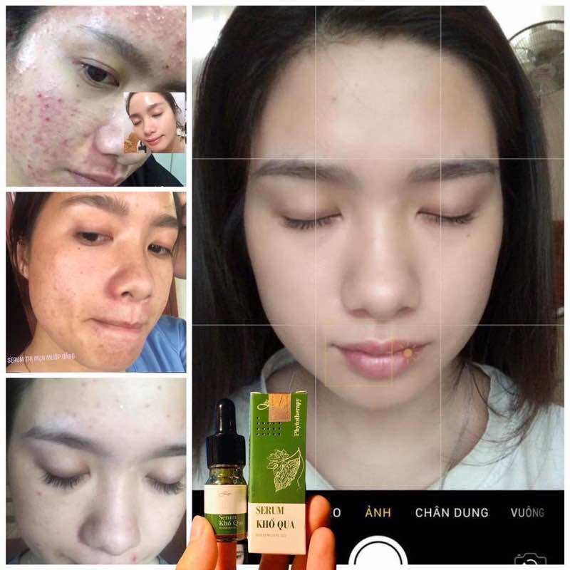SERUM KHỔ QUA LIM - GIẢM THÂM MỤN