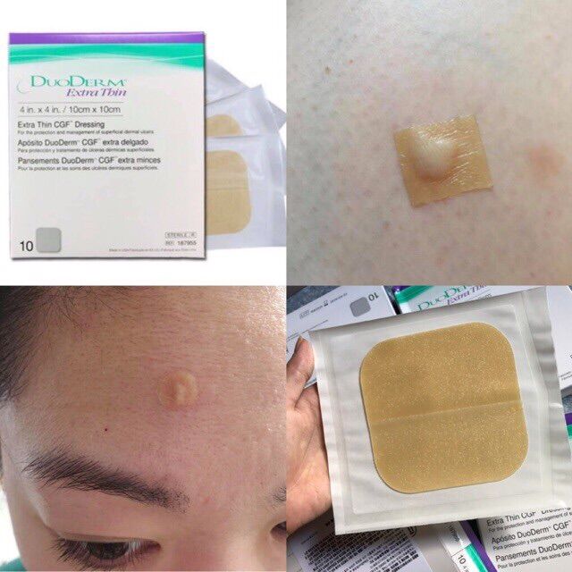 (1 miếng 10x10cm) Miếng dán mụn và vết thương hydrocolloid DuoDerm Extra Thin 10*10cm