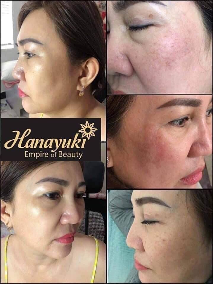 Serum Trị Nám Hanayuki - Hana Melasma