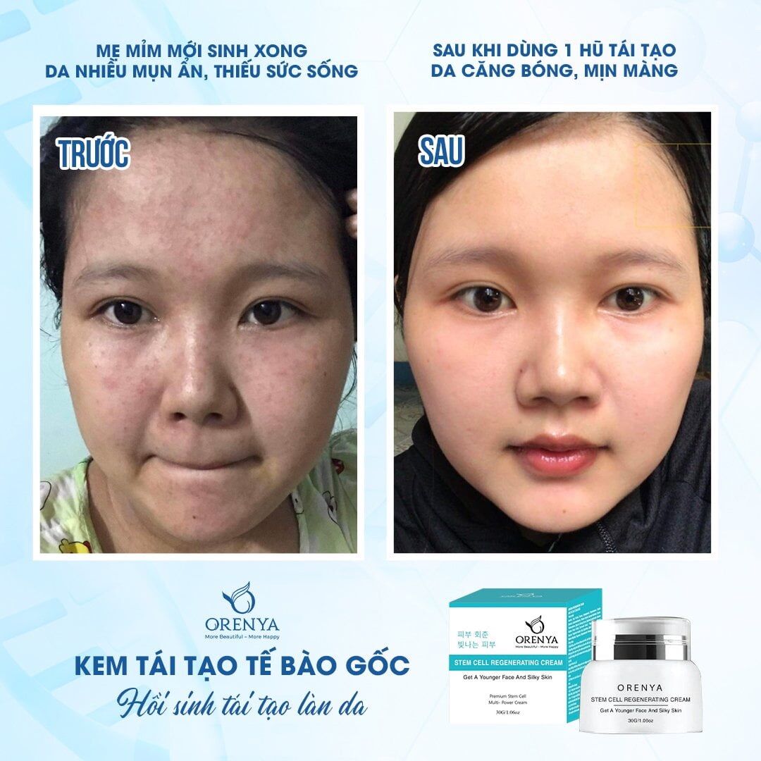 Kem tái tạo tế bào gốc