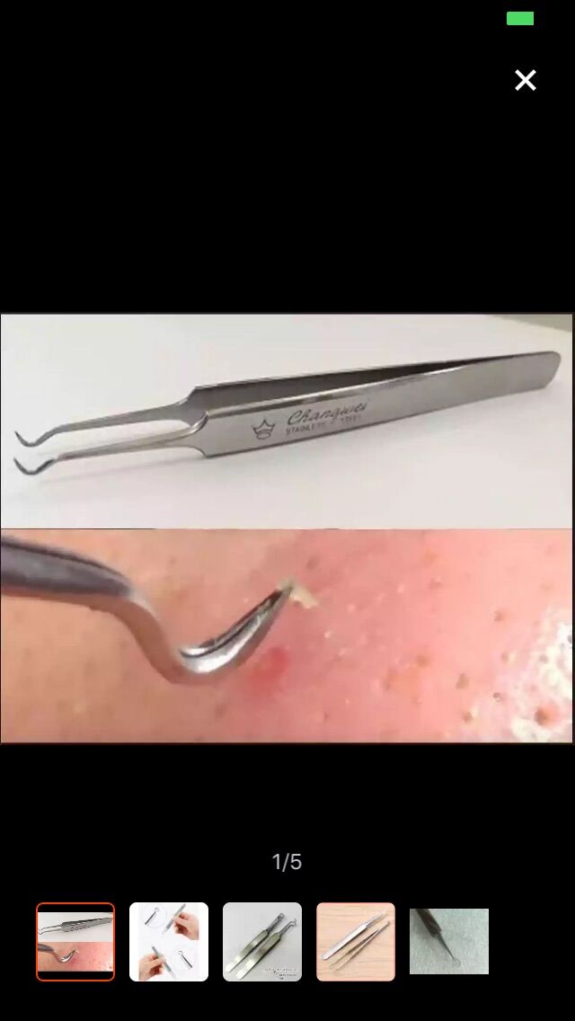1 cây nhíp gấp mụn cám