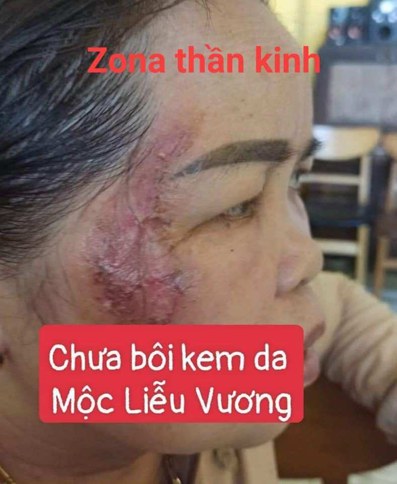 [Mẫu mới] kem bôi da mộc liễu vương lan chi 20gr