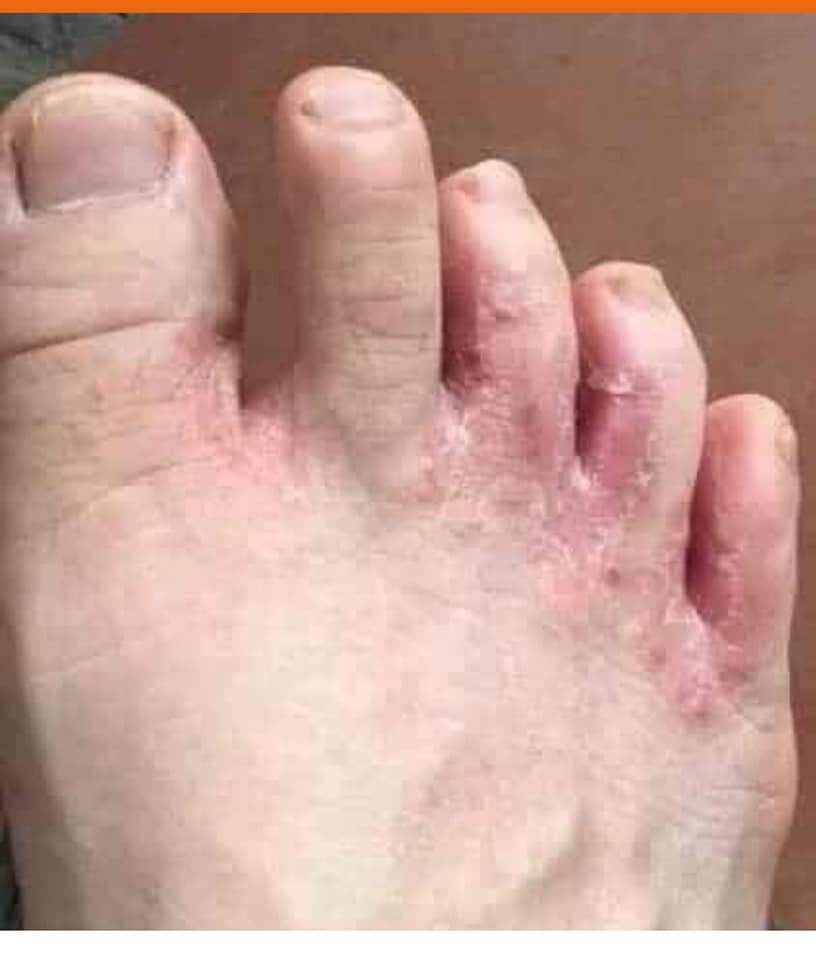 kem bôi da liễu , á sừng , nấm , ngứa nội địa trung chính hãng