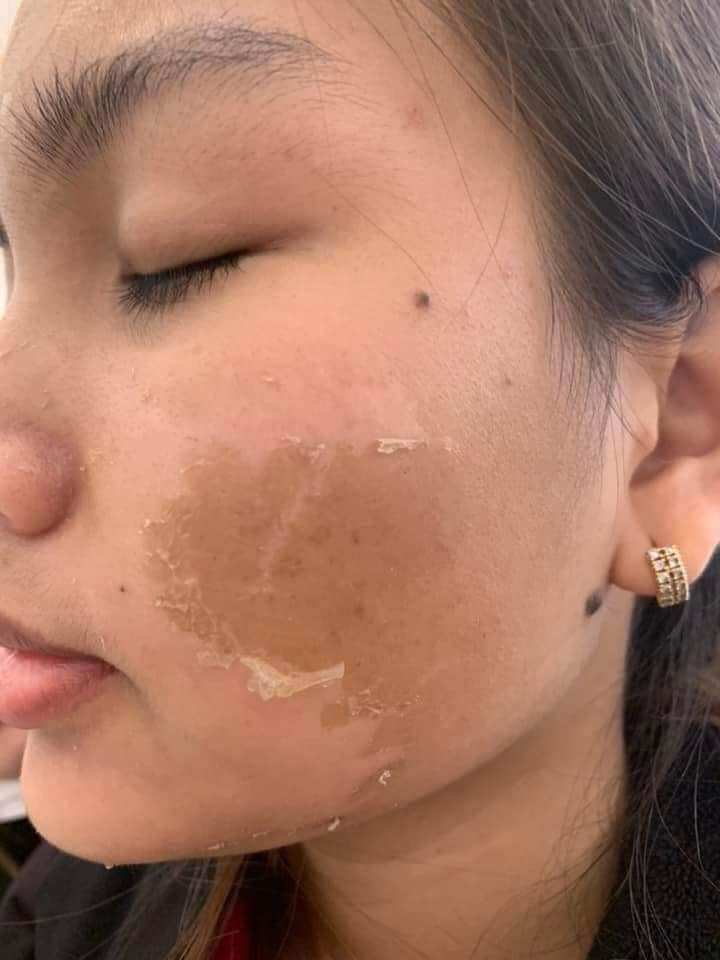 Peel Bong Mạnh Tái Tạo Da