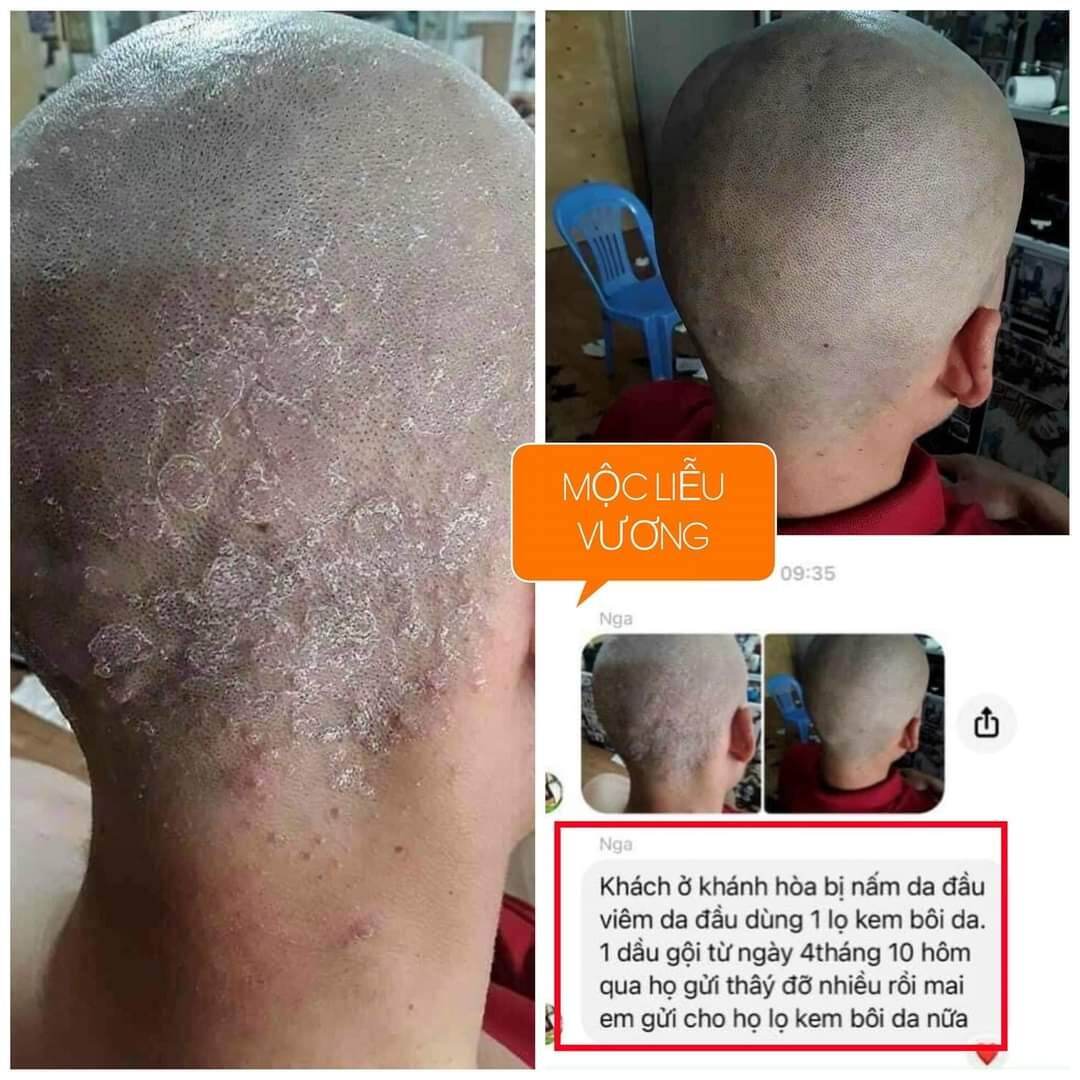 KEM BÔI DA MỘC LIỄU VƯƠNG (KHẮC TINH CÁC BỆNH VỀ DA )