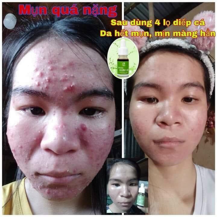 COMBO 3 MÓN SẠCH MỤN IGREEN ( mặt nạ serum và sữa rửa mặt)
