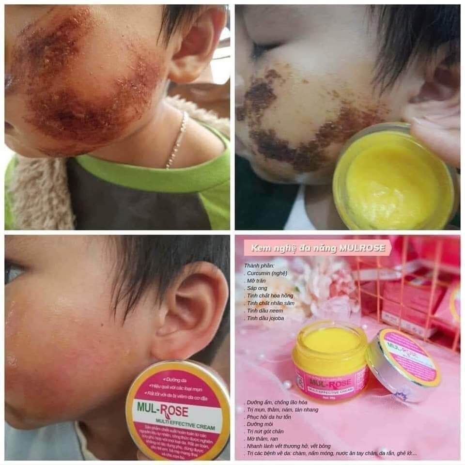 kem nghệ mulrose +serum blackrose