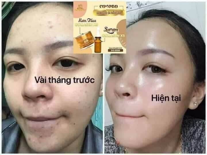 [HCM]KEM FACE COLLAGEN X3 ĐÔNG ANH