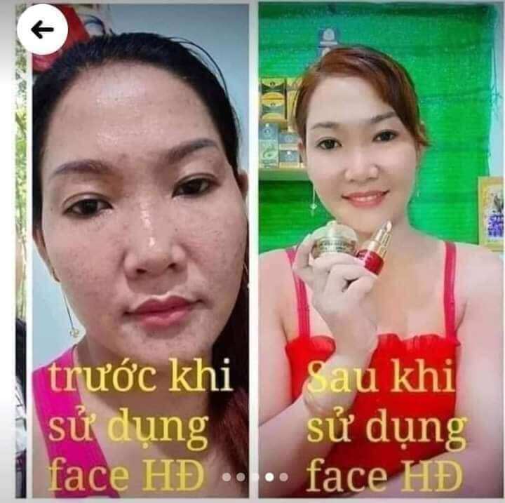 kem face chuyên mụn Huỳnh Đỗ