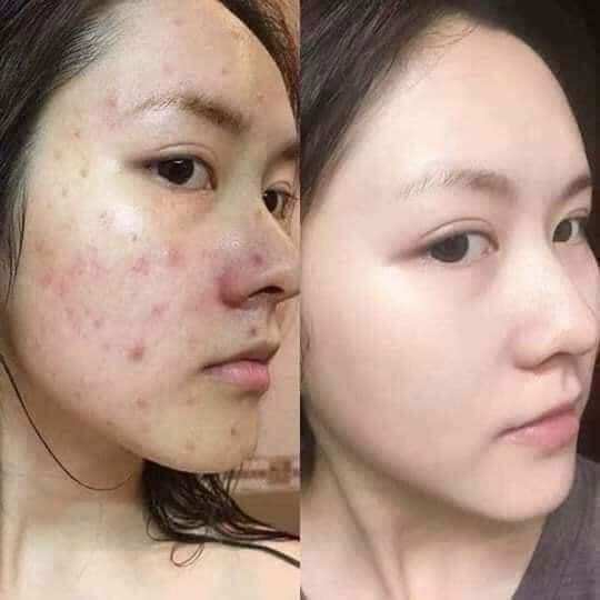 Kem Dưỡng Trắng Da, Mờ Thâm Mụn UB Thái Lan ( ub gói nội địa Thái )