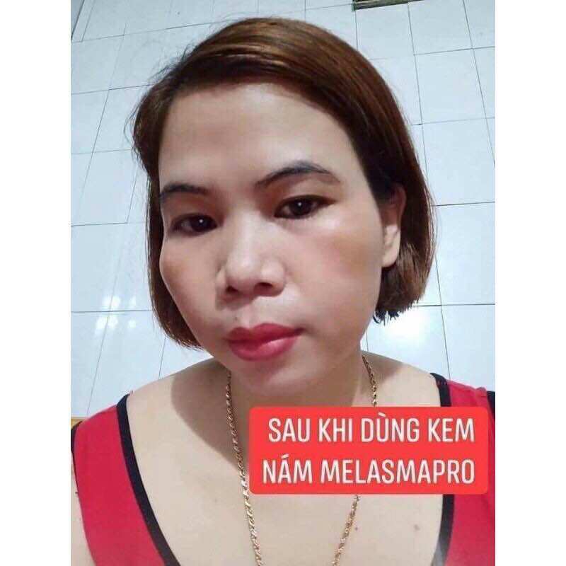 KEM NÁM PRO MELASMA TRẦN KIM HUYỀN