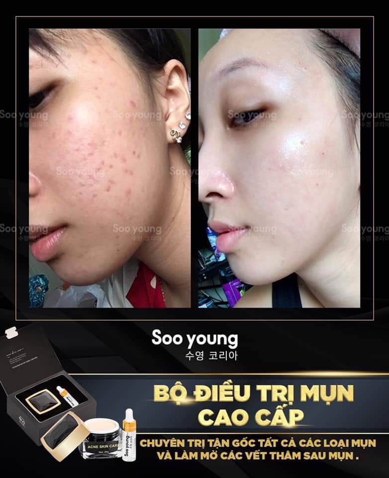 ??Combo Acne Skincare Cao Cấp - Trị Mụn Xóa Thâm Đỉnh Cao Chỉ Trong 2 Tuần