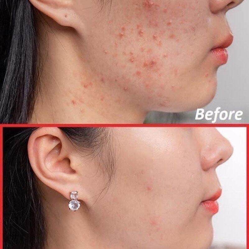 Chấm mụn Isoi Anci Doctor 14ml
