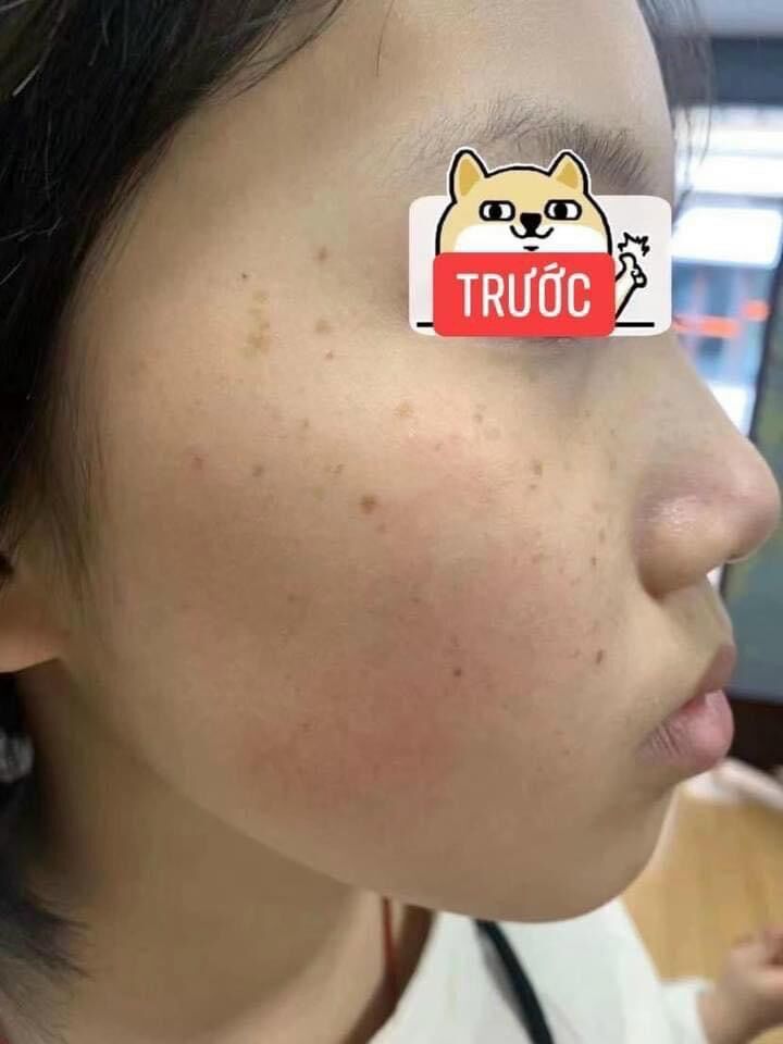 Chấm tàn nhang, nám, mụn ruồi handmade