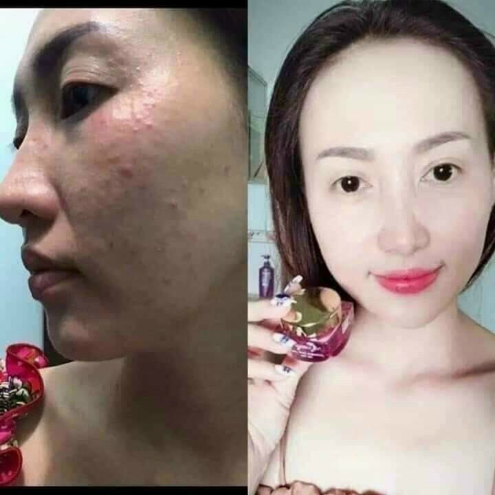Kem face tím giảm mụn ncollagen