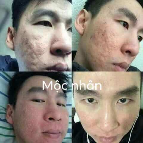 Combo ĐÔNG Y MỘC NHÂN TÁI TẠO DA CẤP