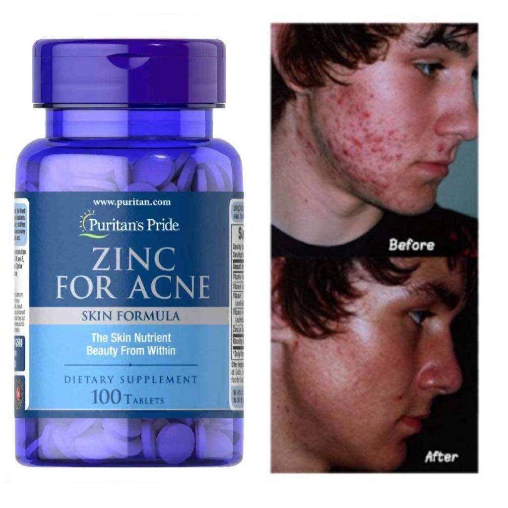 Viên Uống Kẽm Hỗ Trợ Giảm Mụn Puritan's Pride Zinc For Acne 100 Viên