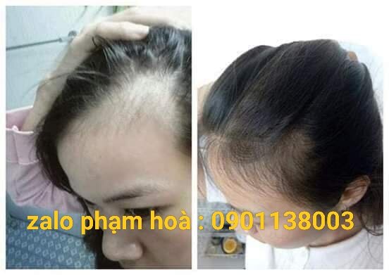 [Mua 4 chai Tặng 1chai ] Tinh Dầu Bưởi Mọc Tóc,Ngăn Rụng Tóc, Giúp Dài Tóc 3-6cm/1 tháng , Tóc Khỏe