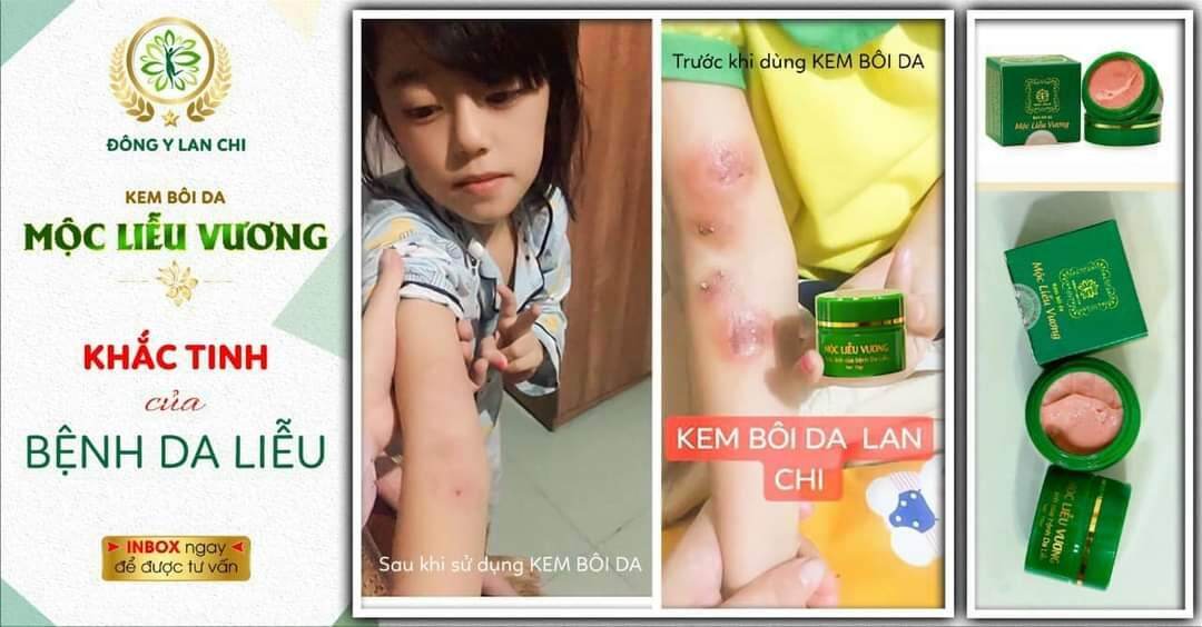 KEM BÔI DA MỘC LIỄU VƯƠNG (KHẮC TINH CÁC BỆNH VỀ DA )