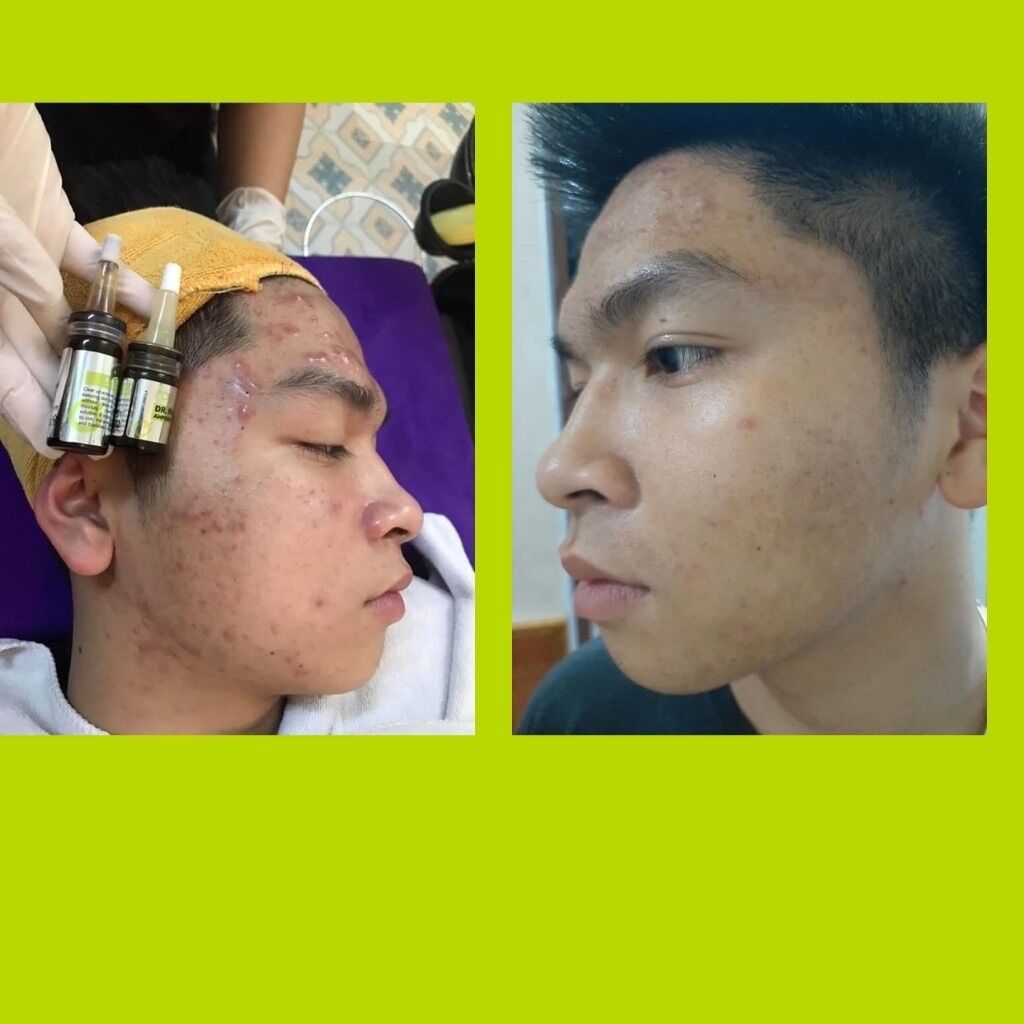 Tế Bào Gốc Mụn Dr. Face Ampoule AC Clear - Ron International