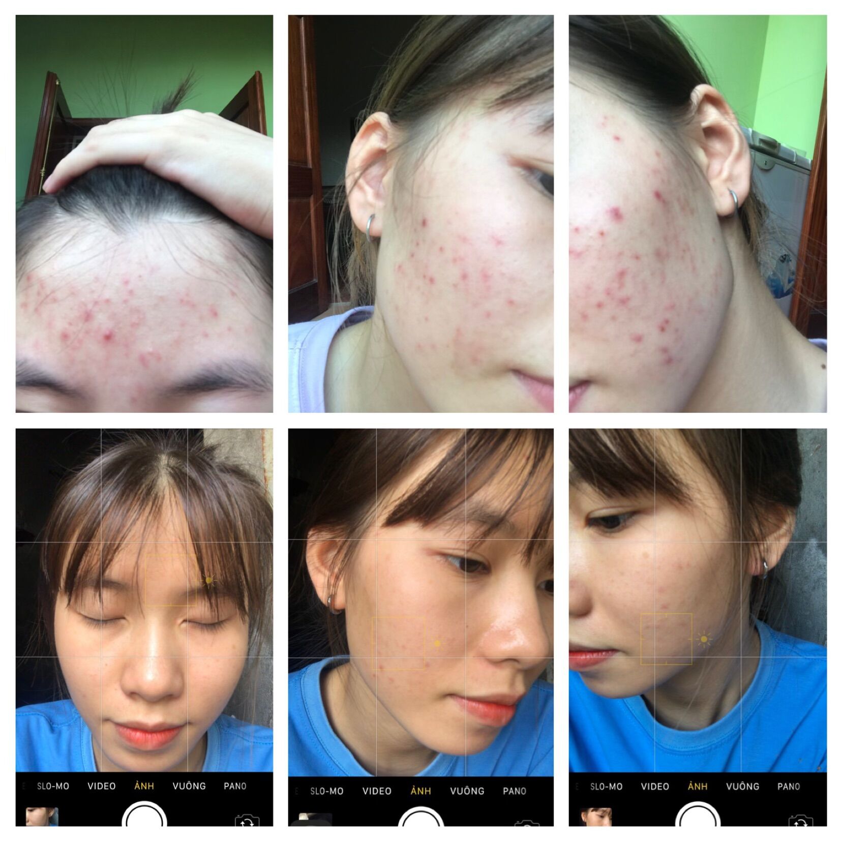 THẢO DƯỢC SẠCH MỤN MT TẶNG LỘT MỤN (giá sỉ)
