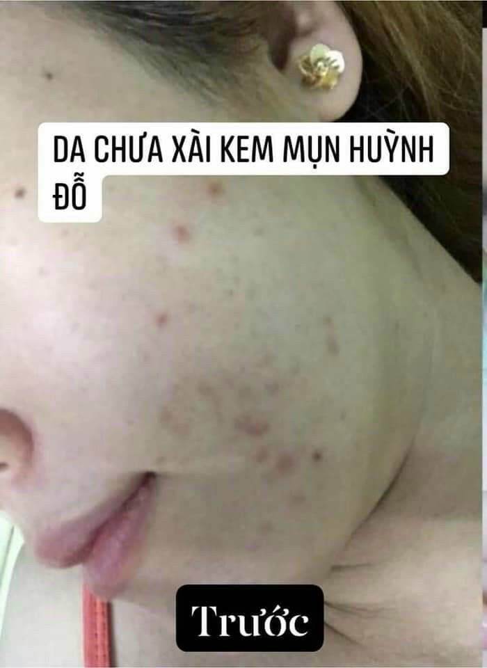 Kem Mụn Huỳnh Đỗ